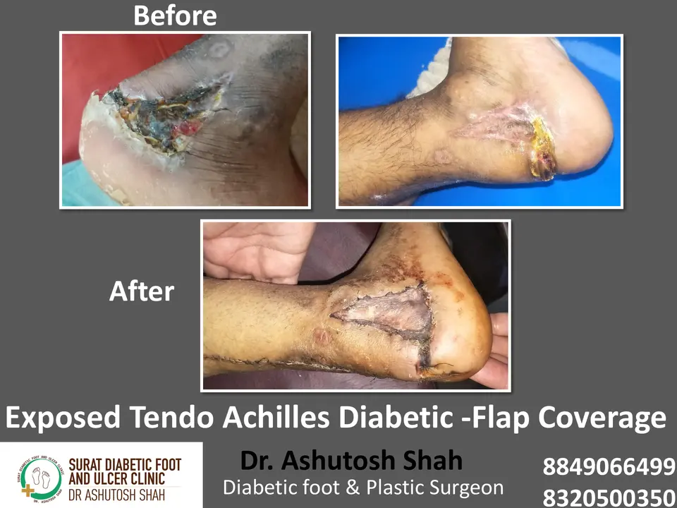 Diabetic Foot  PPT 3 checked by sir.pptx-99.webp